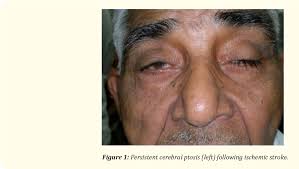 Cerebral Ptosis